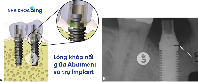 rang-implant-bi-lung-lay