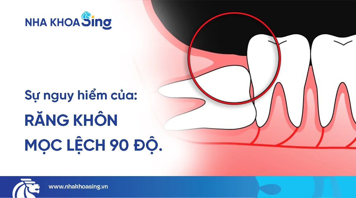 Răng khôn mọc lệch 90 độ: Nên nhổ hay nên giữ?