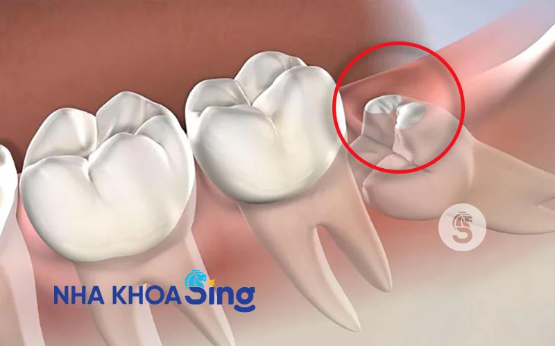 rang-khon-moi-nhu-co-nho-duoc-khong