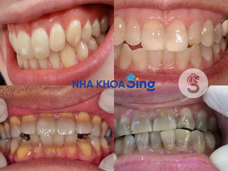 rang-nhiem-tetracycline-1