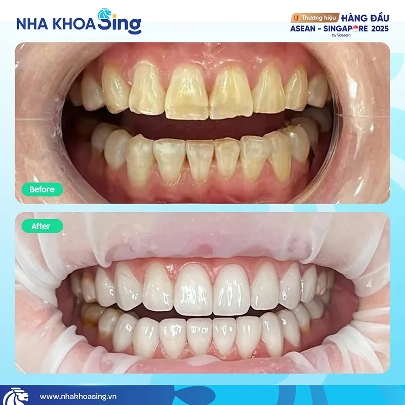 rang-nhiem-tetracycline-3