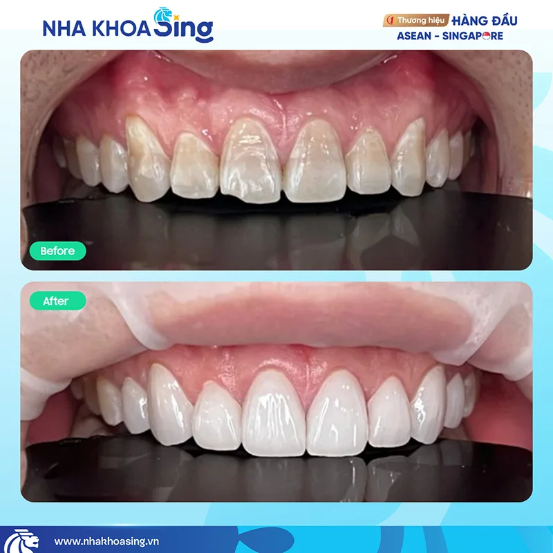 rang-nhiem-tetracycline-4