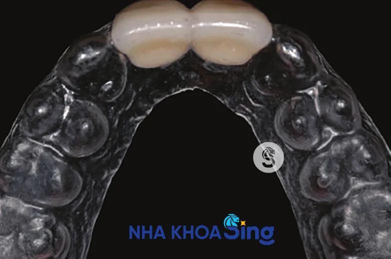 rang-tam-tren-implant-1