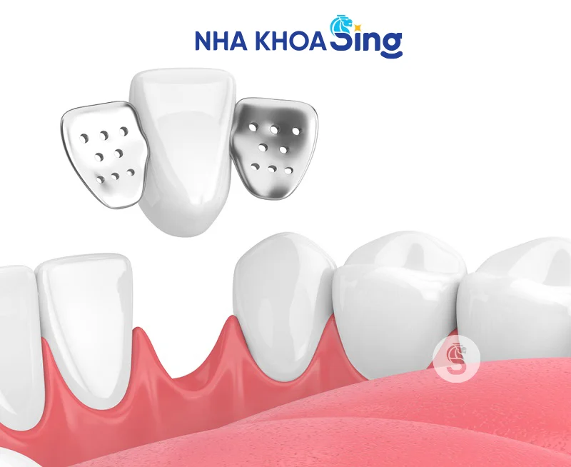 Rang-tam-tren-implant-2