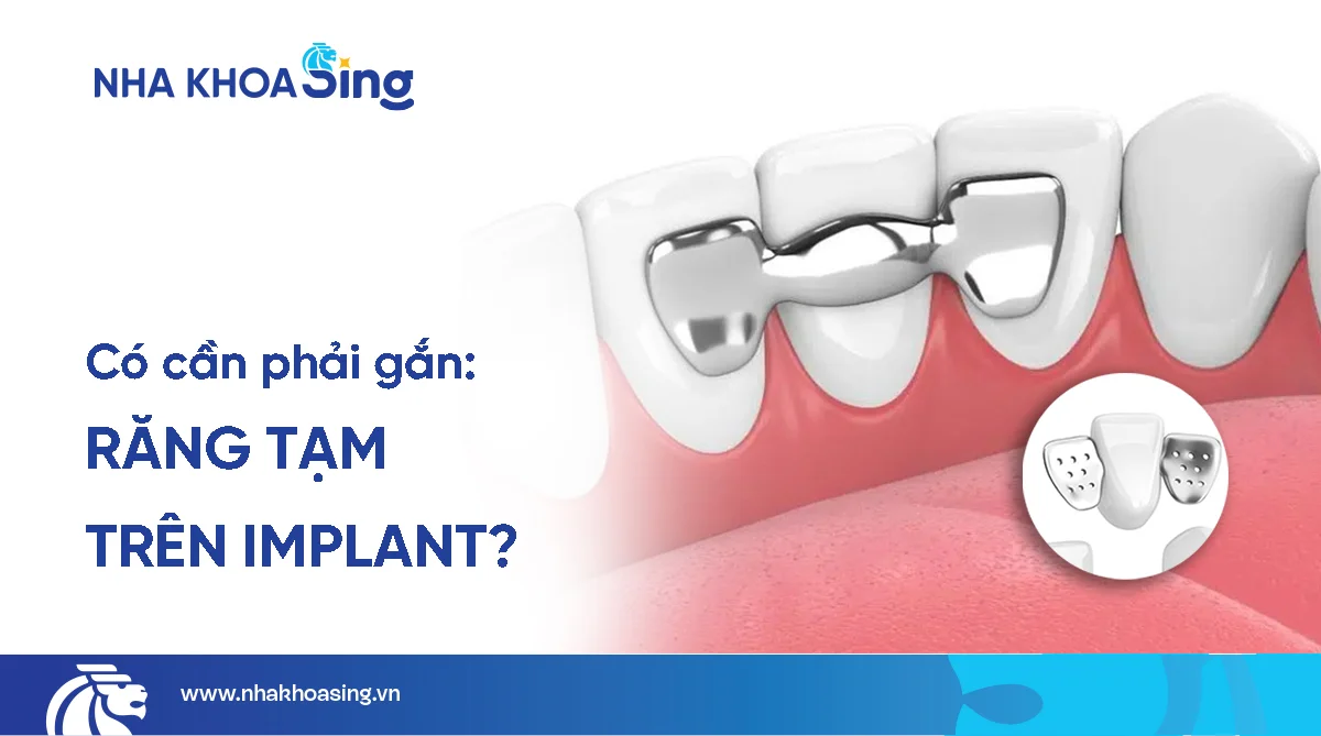 Răng tạm trên implant là gì? Có nên gắn không?