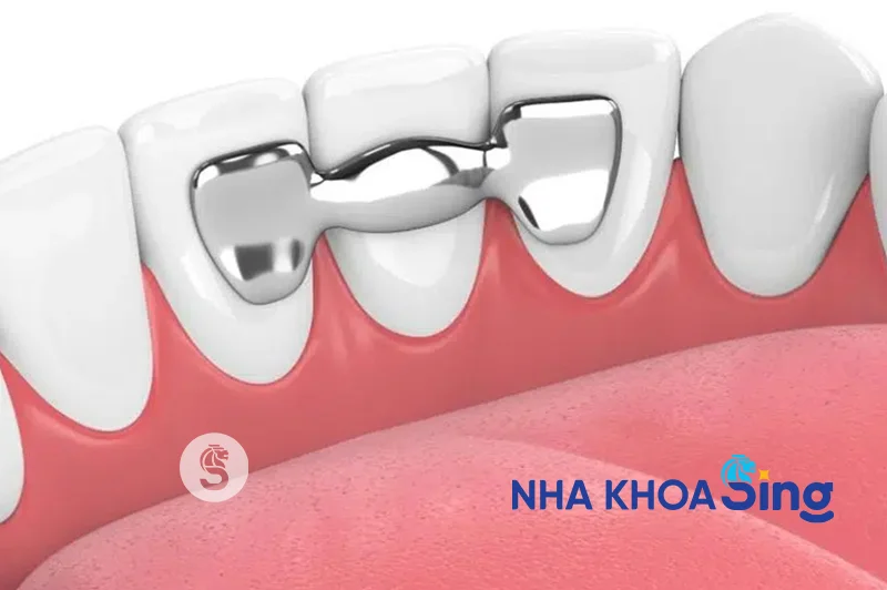 rang-tam-tren-implant