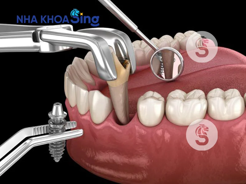 sau-khi-nho-rang-bao-lau-thi-trong-implant-1
