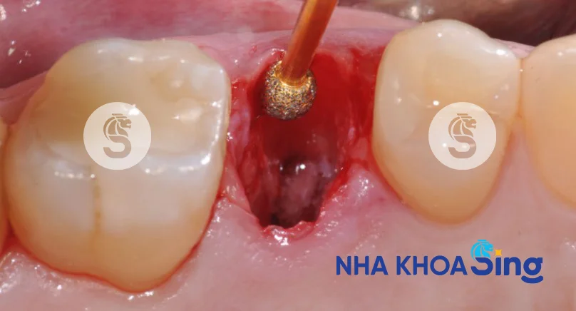 sau-khi-nho-rang-bao-lau-thi-trong-implant-2