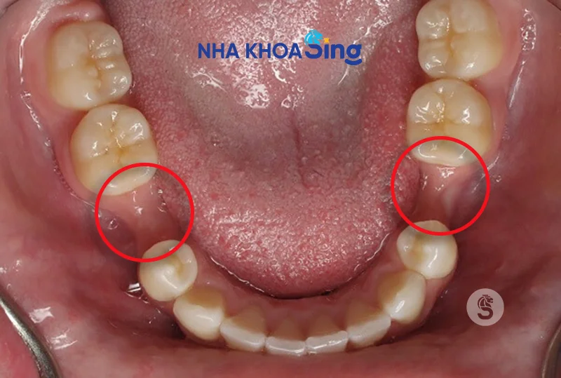 sau-khi-nho-rang-bao-lau-thi-trong-implant-3