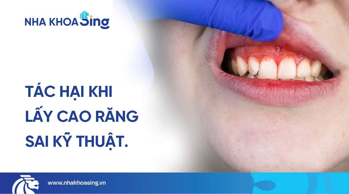 Tác hại của việc lấy cao răng sai cách và cách phòng tránh
