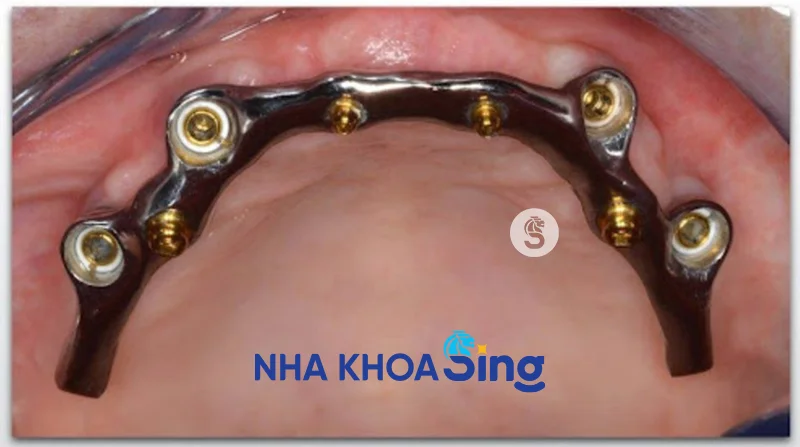 thanh-bar-tren-implant-1