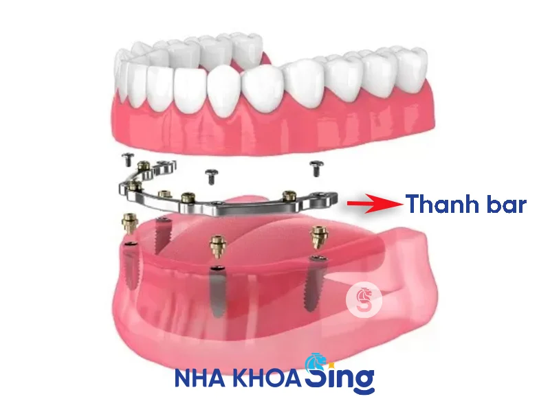 thanh-bar-tren-implant