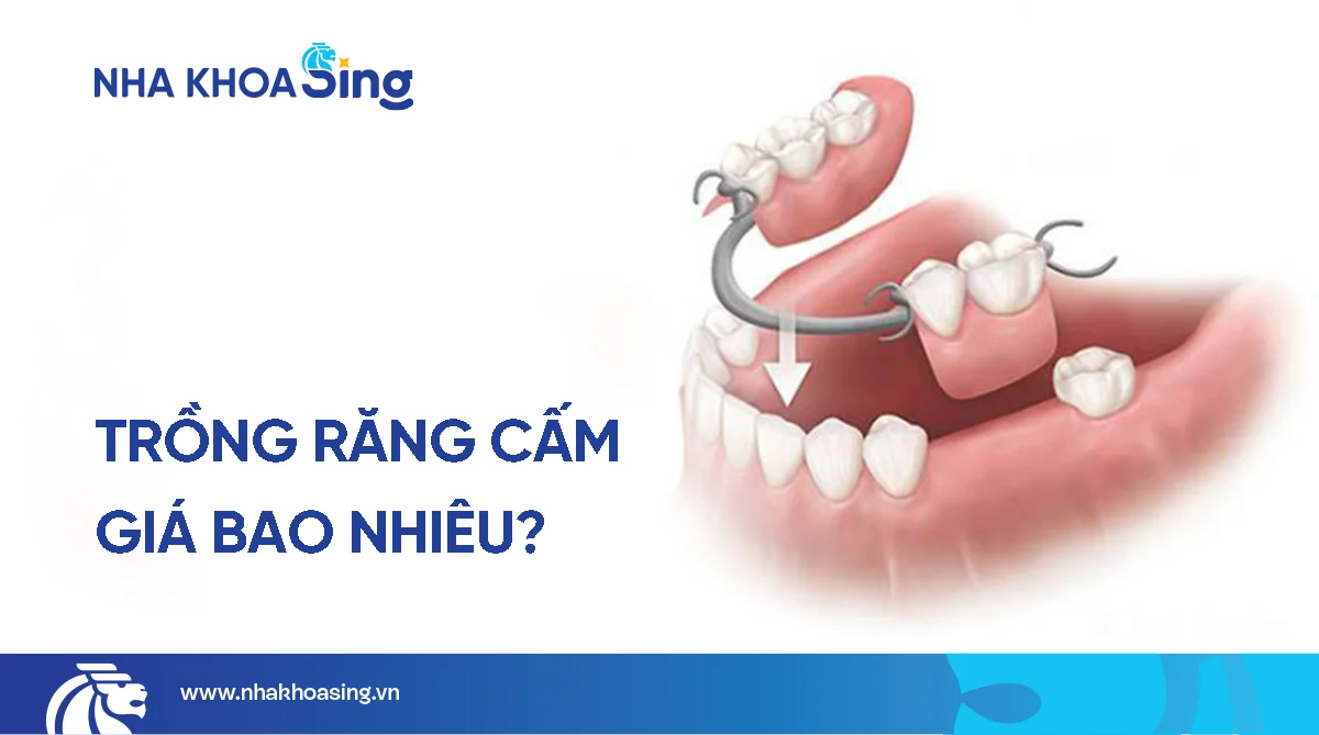 Trồng răng cấm giá bao nhiêu? Cập nhật bảng giá mới nhất 2025