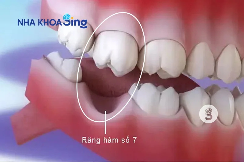 trong-rang-ham-so-7-gia-bao-nhieu-1