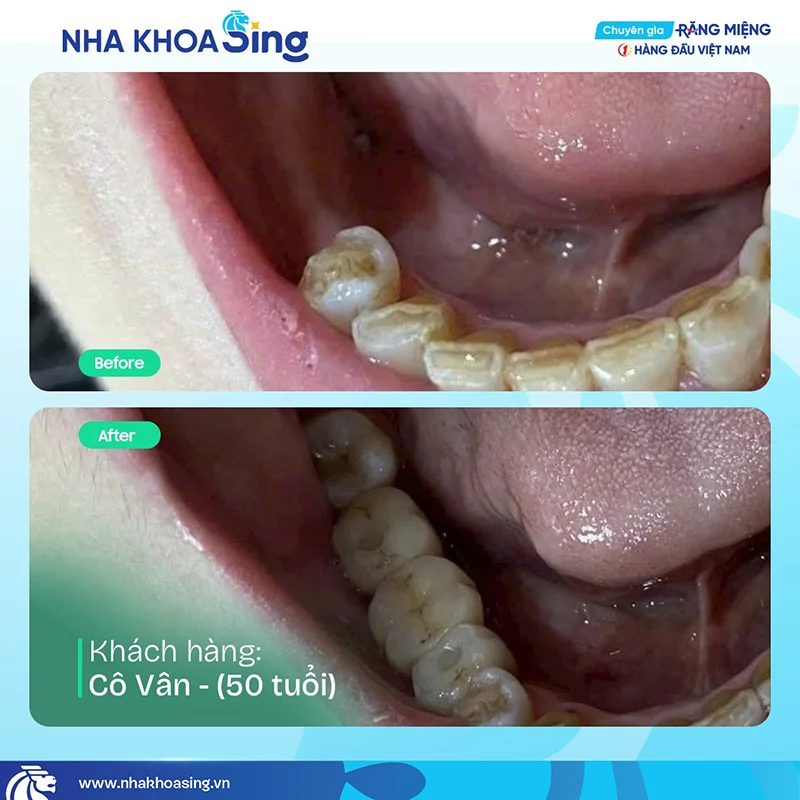 trong-rang-implant-7