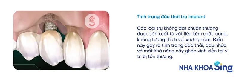 trong-rang-implant-co-nguy-hiem-khong-1