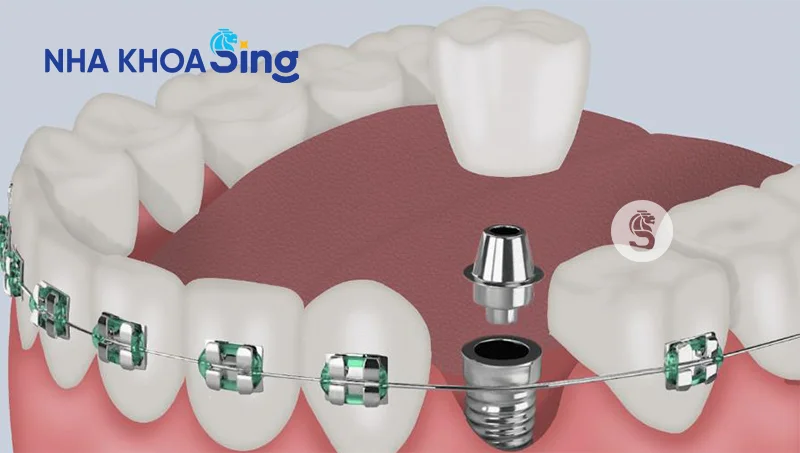 trong-rang-implant-co-nieng-rang-duoc-khong-1