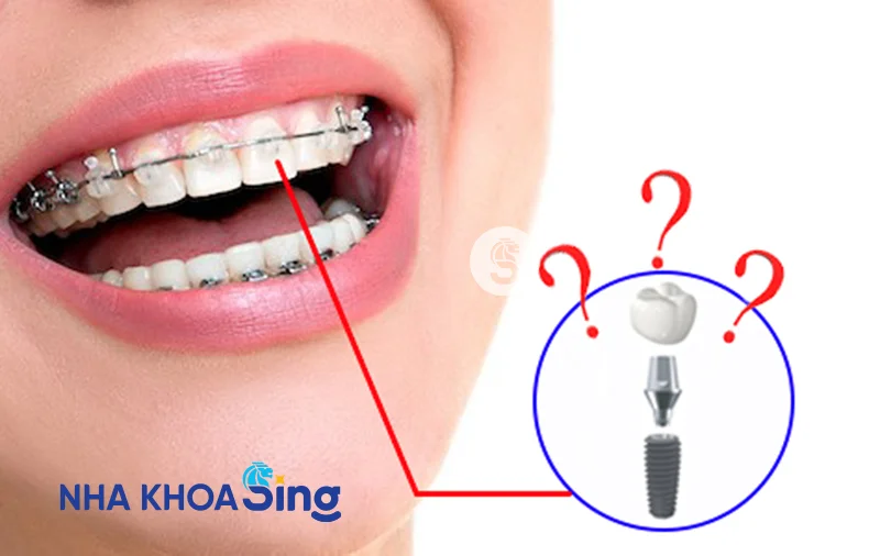 trong-rang-implant-co-nieng-rang-duoc-khong