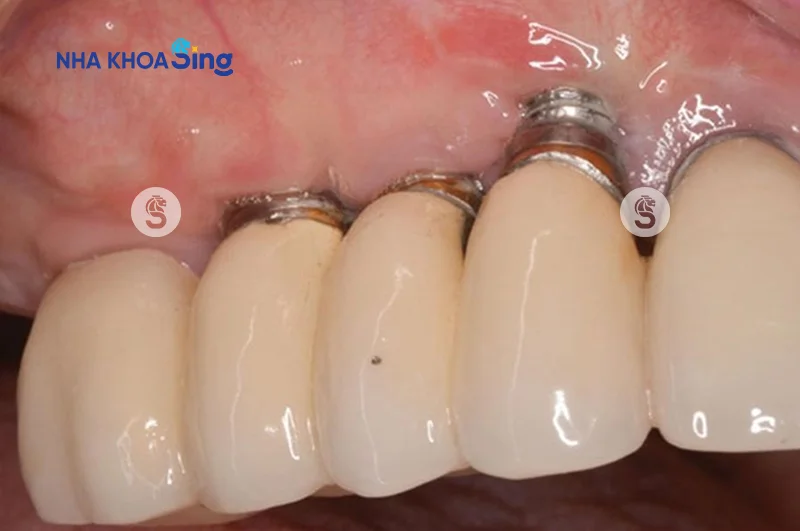 trong-rang-implant-gia-re-1