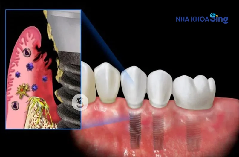 trong-rang-implant-gia-re-2