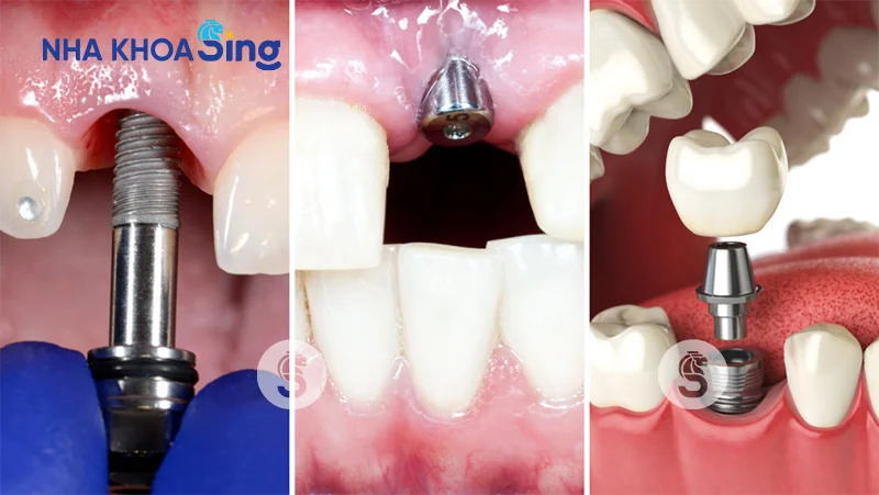 trong-rang-implant-mat-bao-lau-1