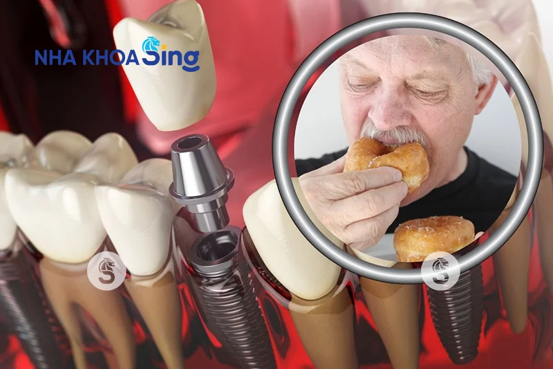 trong-rang-implant-mat-bao-lau-2