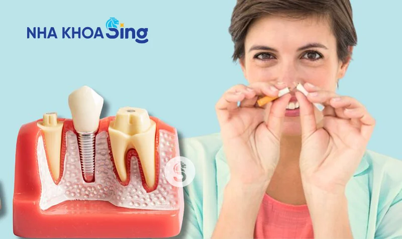 trong-rang-implant-mat-bao-lau-3