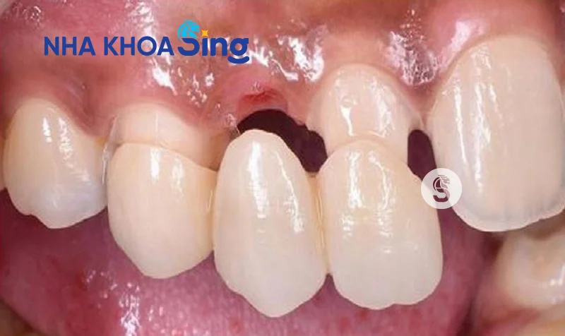 trong-rang-nanh-1