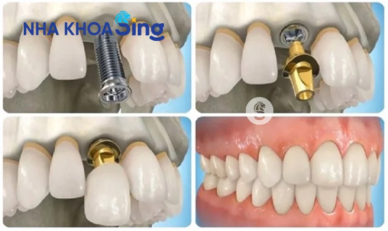 trong-rang-nanh-2