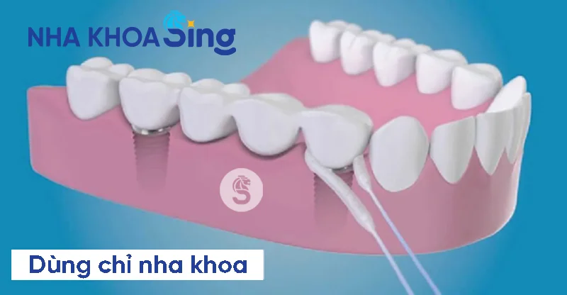 ve-sing-rang-implant-2