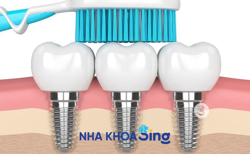 ve-sinh-rang-implant-1