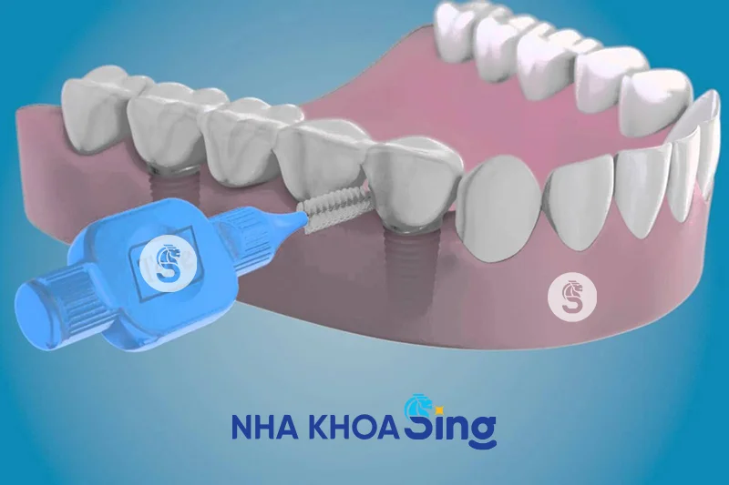 ve-sinh-rang-implant-3