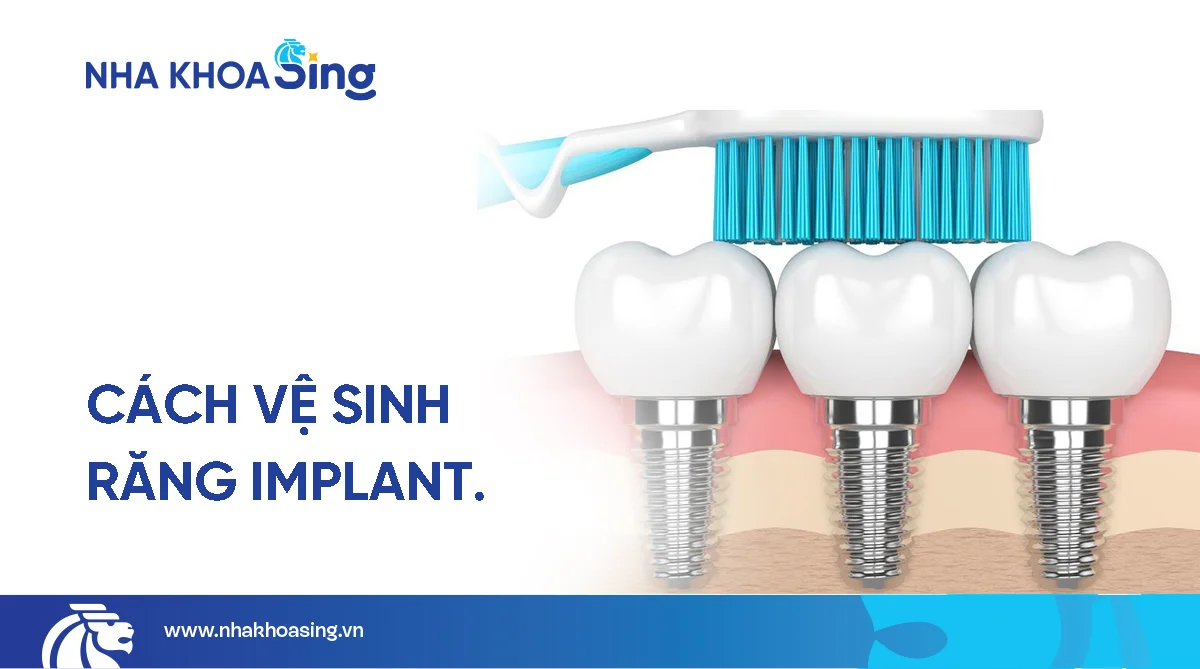 Cách vệ sinh răng Implant đúng cách giúp giữ răng giả bền đẹp
