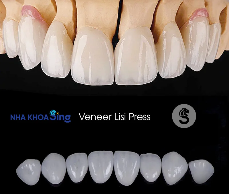 veneer-lisi-2