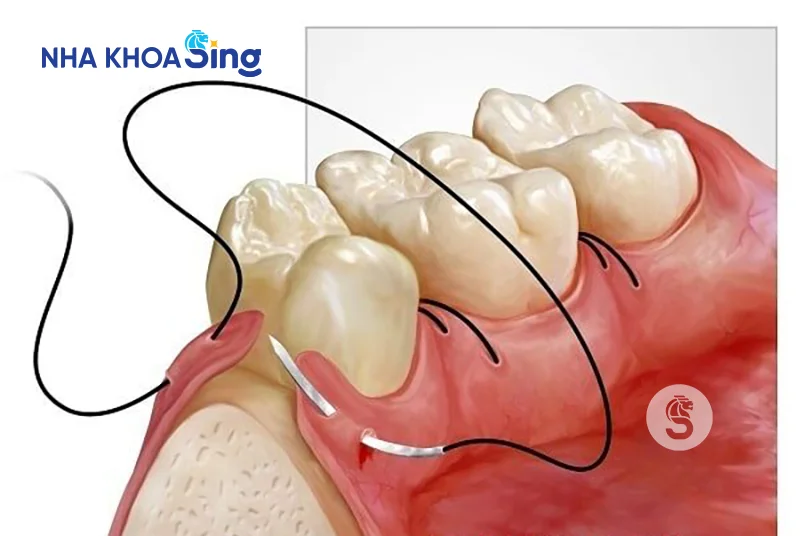 vet-khau-nho-rang-khon-bi-ho-1