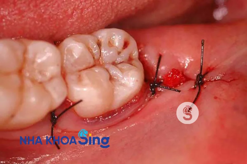 vet-khau-nho-rang-khon-bi-ho