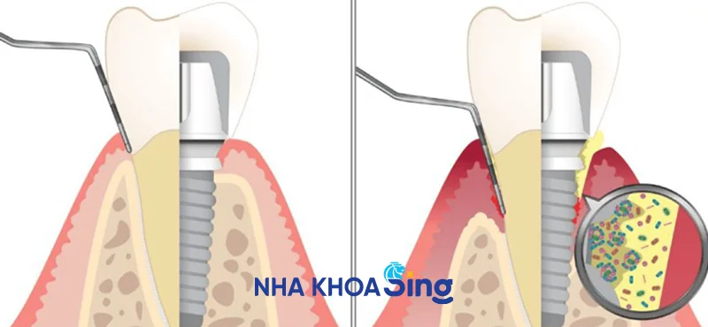 viem-quanh-implant-1