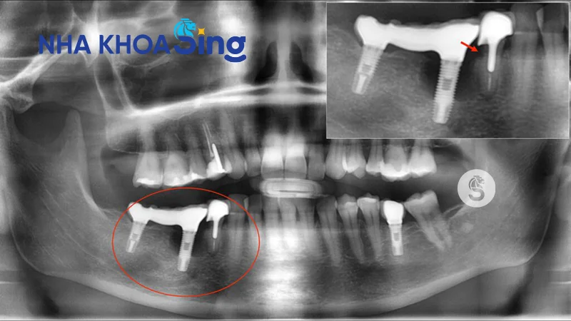 viem-quanh-implant-2