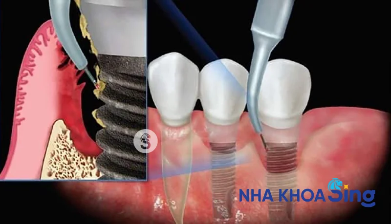 viem-quanh-implant-3