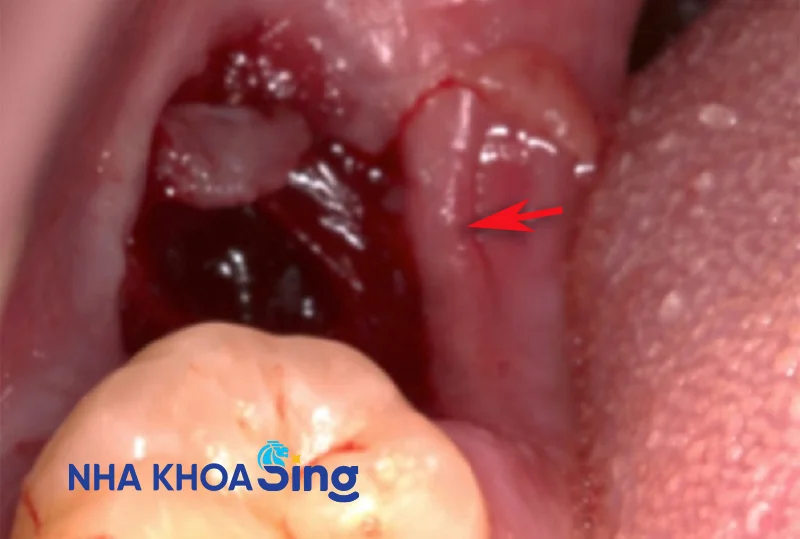xet-nghiem-mau-nho-rang-khon-1