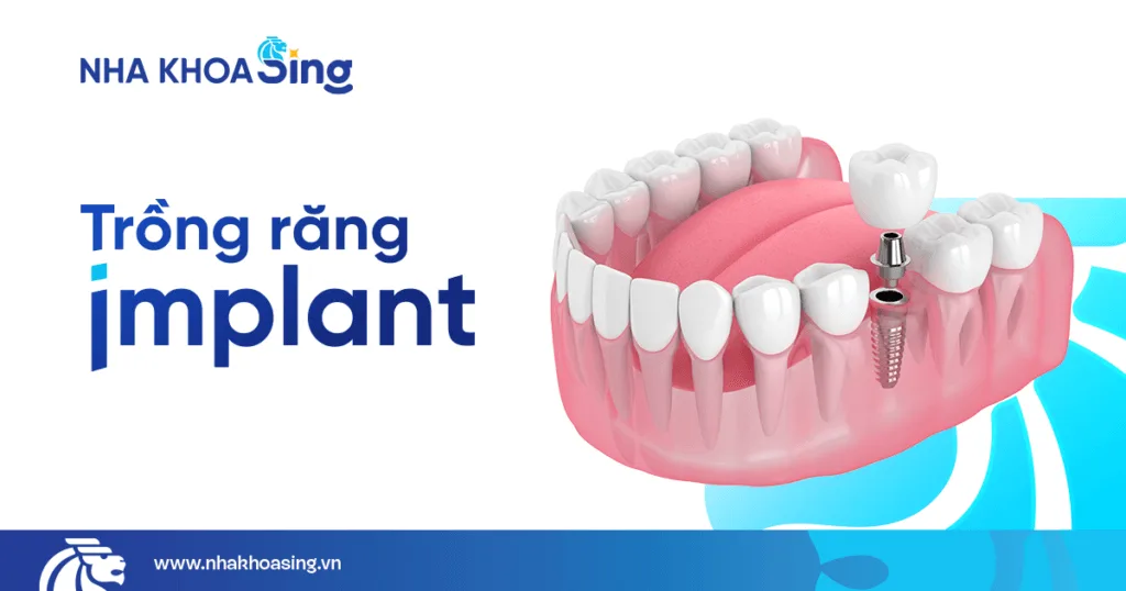 Dịch vụ trồng răng implant tại Nha khoa Sing