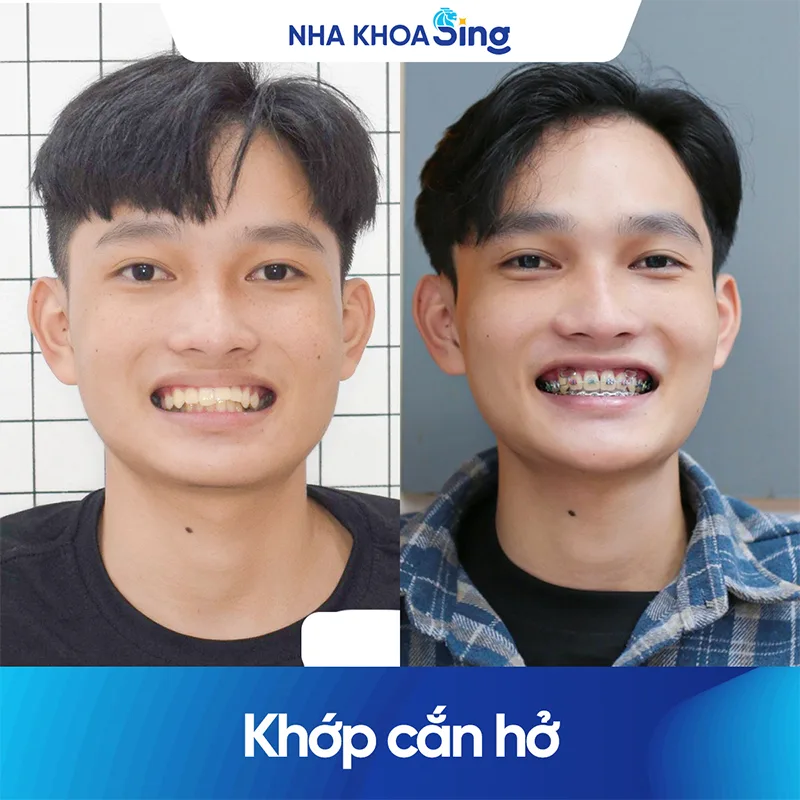 hinh-anh-khach-hang-nieng-rang-mac-cai-kim-loai-nha-khoa-sing-1