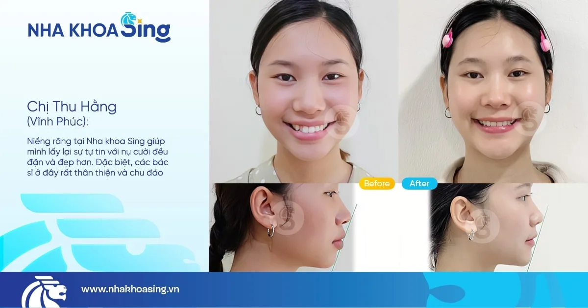 hinh-anh-khach-nieng-rang-tai-nha-khoa-sing-1