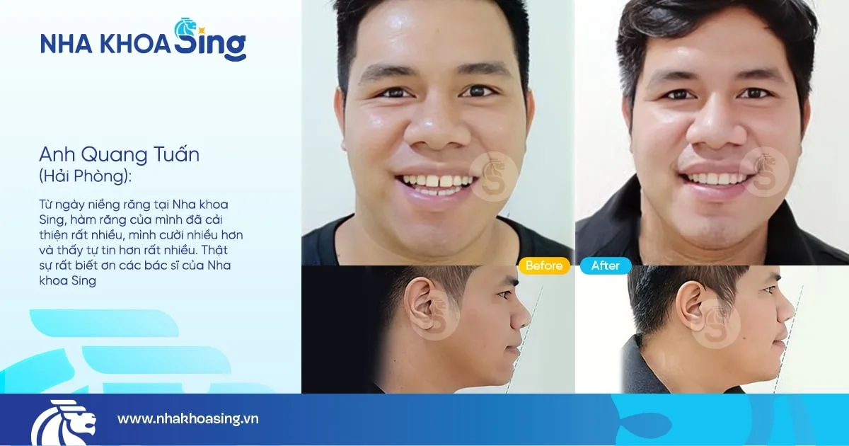 hinh-anh-khach-nieng-rang-tai-nha-khoa-sing