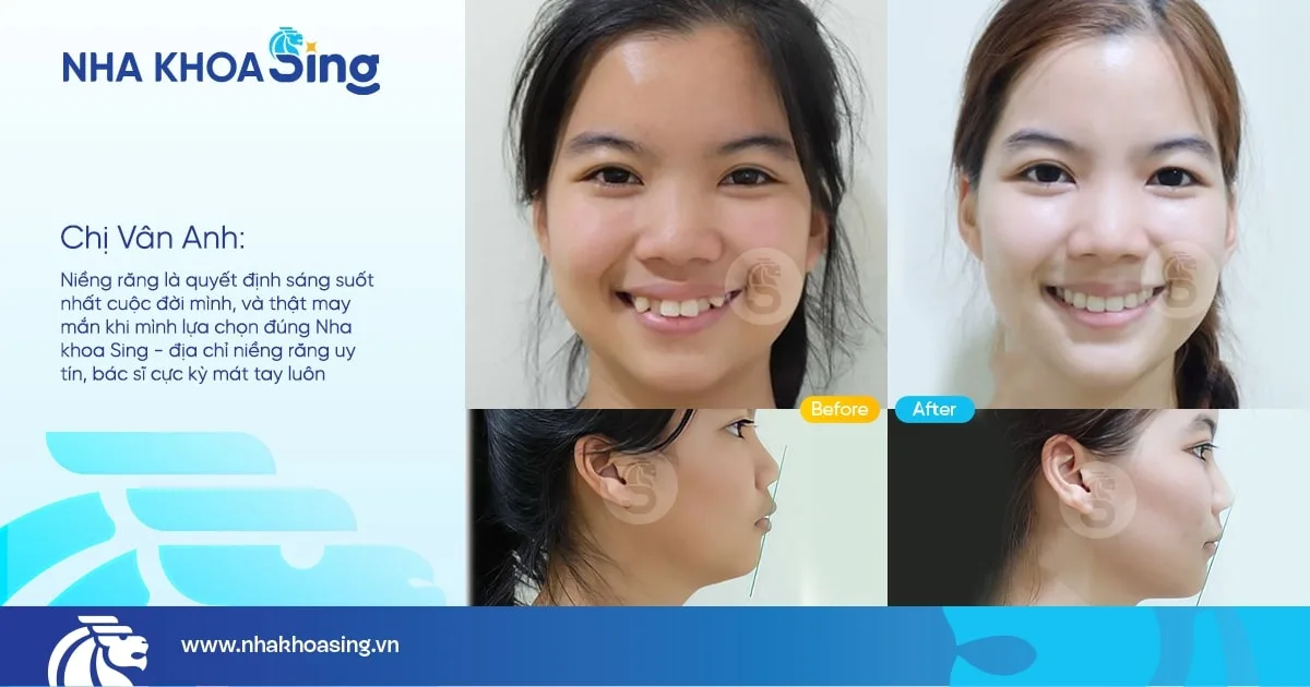 hinh-anh-khach-nieng-rang-tai-nha-khoa-sing