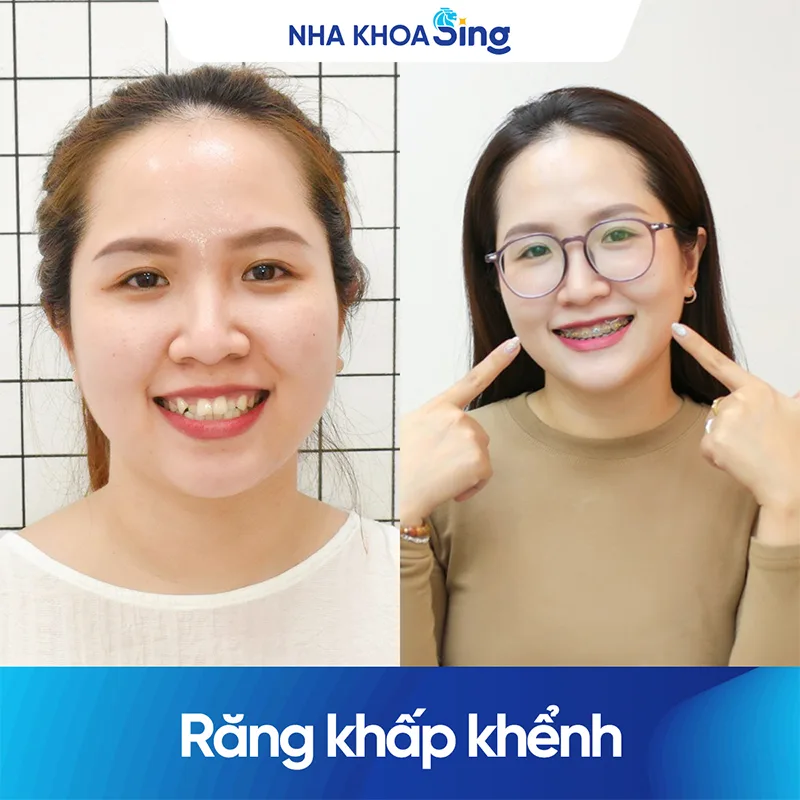 khach-hang-nho-rang-khenh-nha-khoa-sing