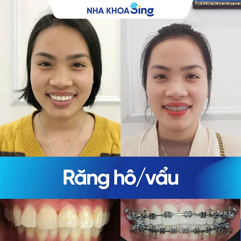 khach-hang-nieng-rang-mac-cai-kim-loai-nha-khoa-sing