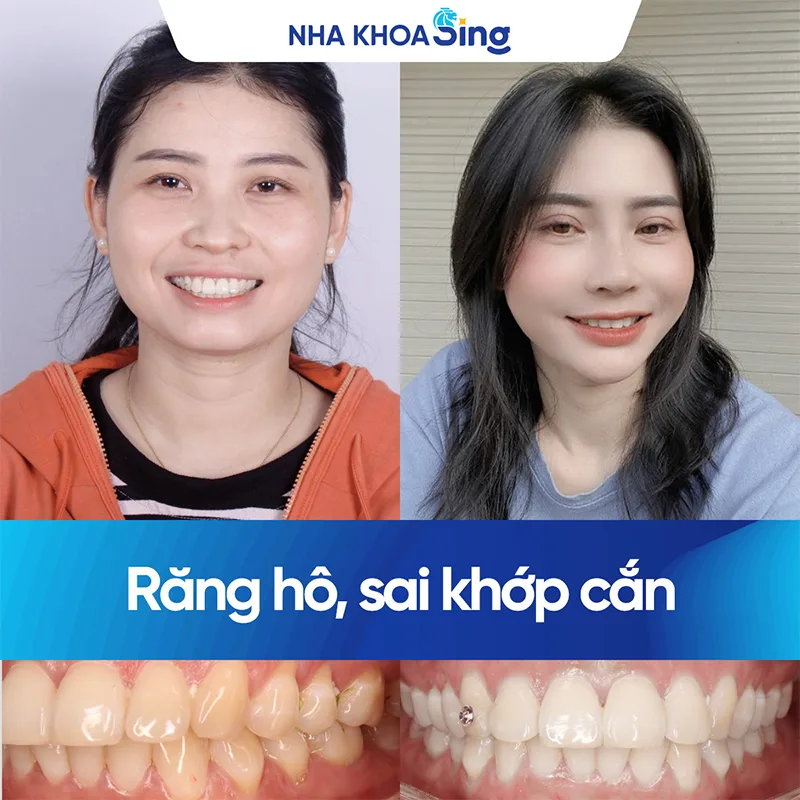 khach-hang-nieng-rang-trong-suot-nha-khoa-sing-1