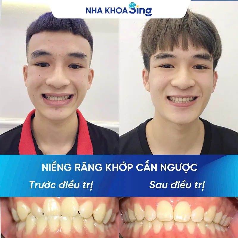 nieng-rang-khop-can-nguoc-1-1