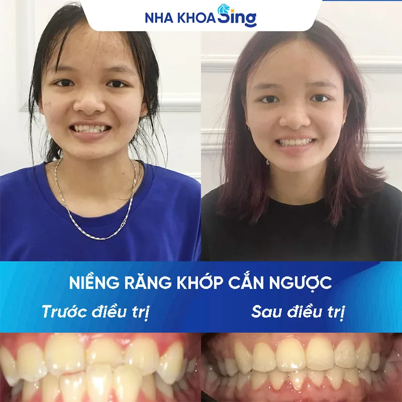 nieng-rang-khop-can-nguoc-2